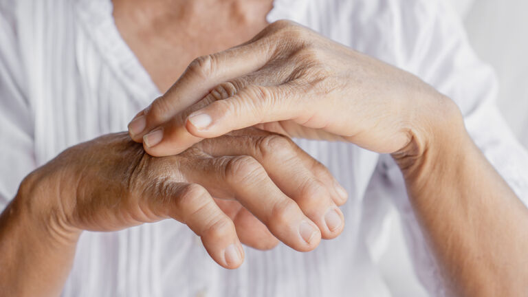 Zwei Hände mit Gichtknoten. Die eine Hand tastet die andere Hand ab.