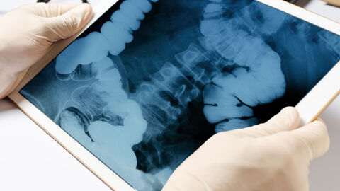 Röntgenaufnahme des Darms